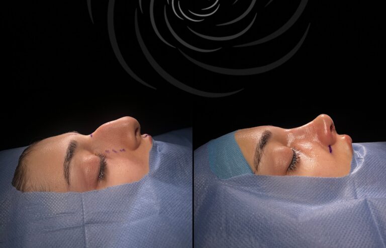 chirurgia nosa 1 5