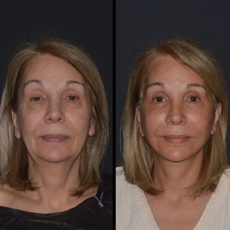 chirurgia twarzy 1 1