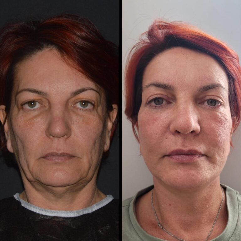 chirurgia twarzy 1 11