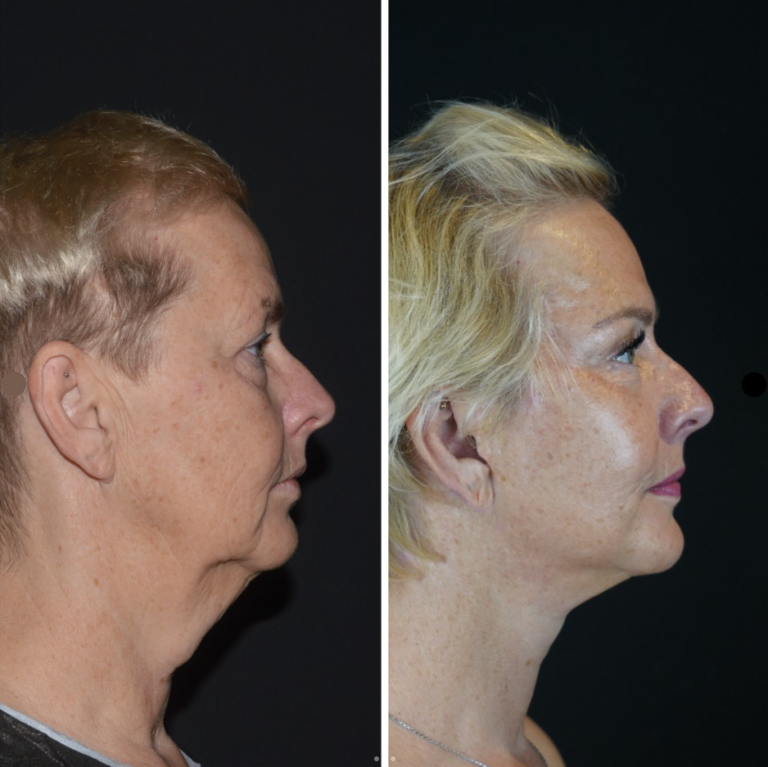 chirurgia twarzy 1 15