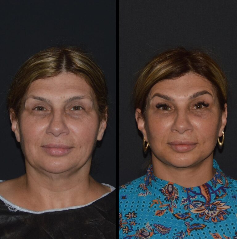 chirurgia twarzy 1 3