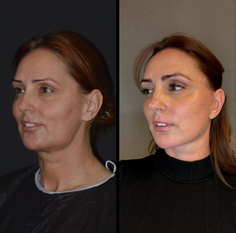 chirurgia twarzy 1 4