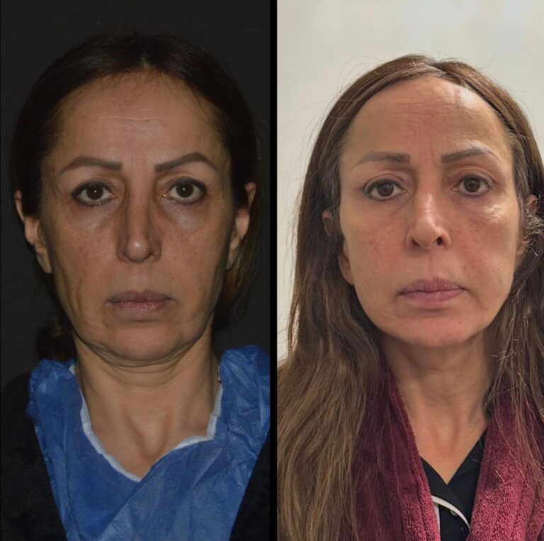 chirurgia twarzy 1 5