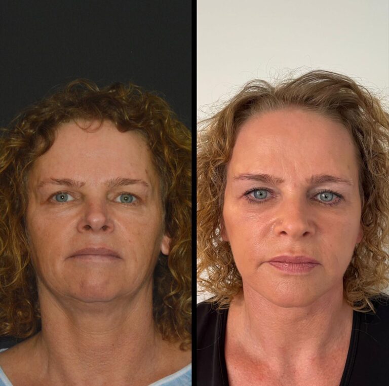 chirurgia twarzy 1 5