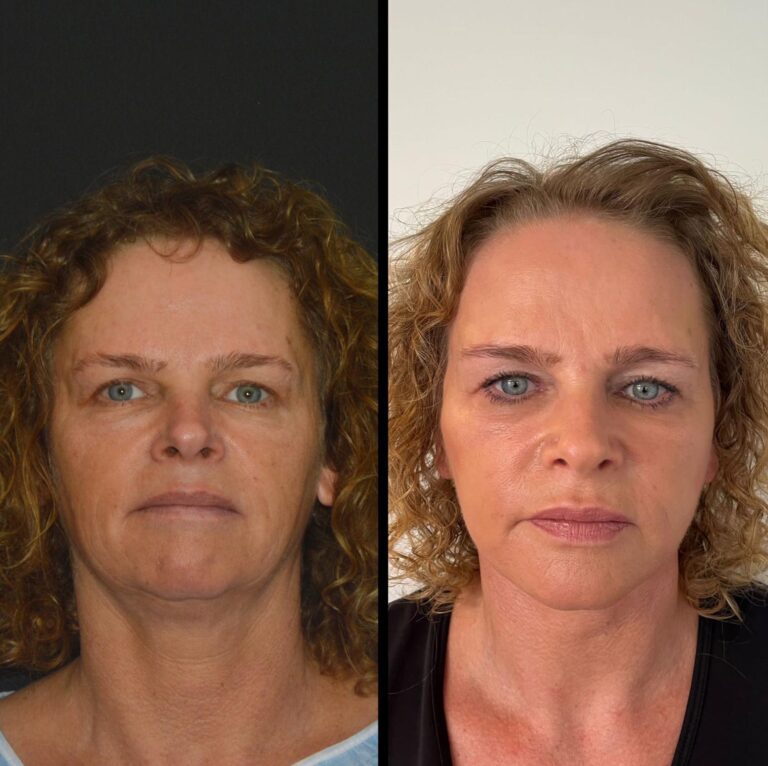 chirurgia twarzy 1 7