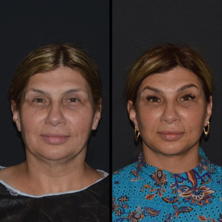 chirurgia twarzy 1 9