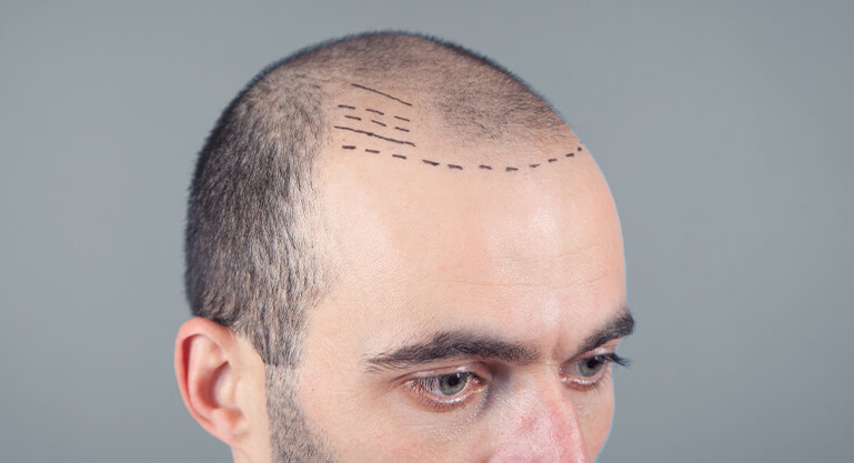 1 Przeszczep Włosów