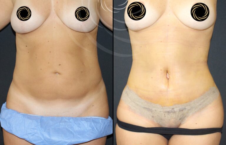plastyka brzucha 1 1