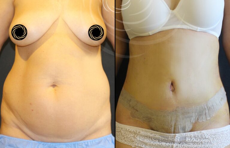 plastyka brzucha 1 13
