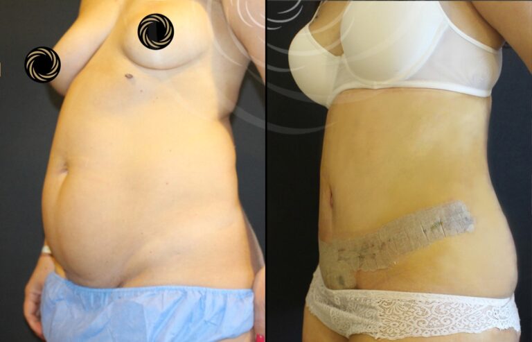 plastyka brzucha 1 14