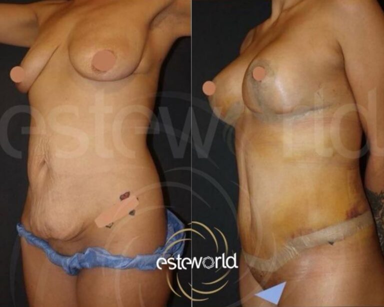 plastyka brzucha 1 15