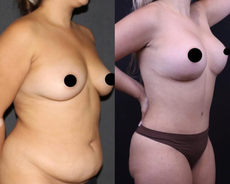 plastyka brzucha 1 2