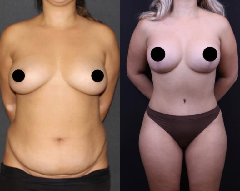 plastyka brzucha 1 2