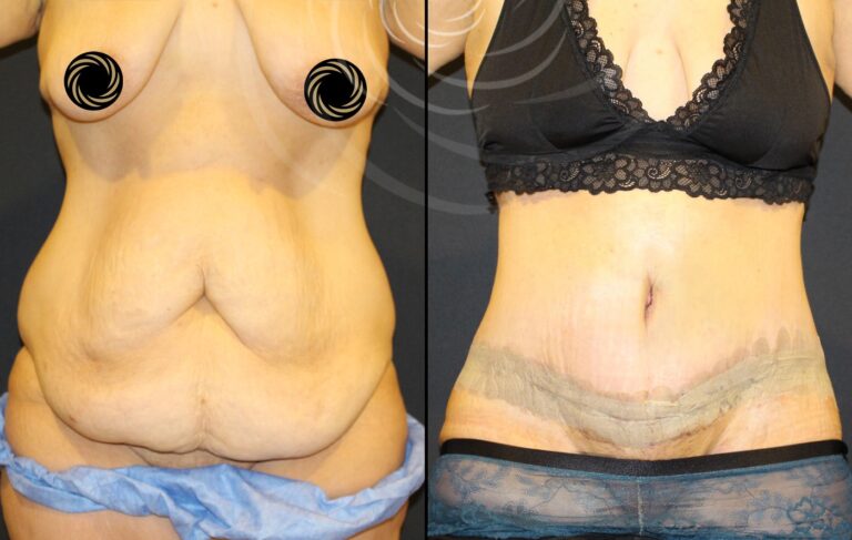 plastyka brzucha 1 3