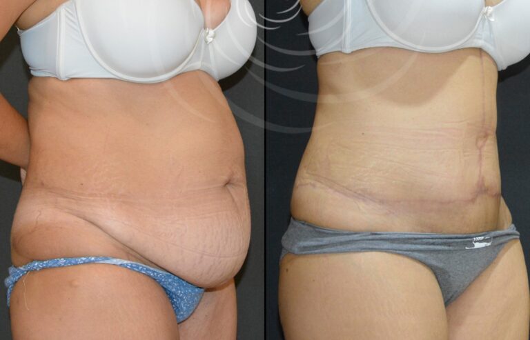 plastyka brzucha 1 3