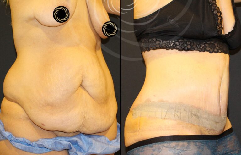 plastyka brzucha 1 4