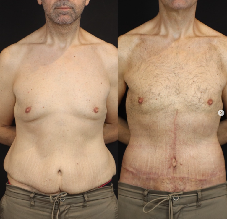 plastyka brzucha 1 5