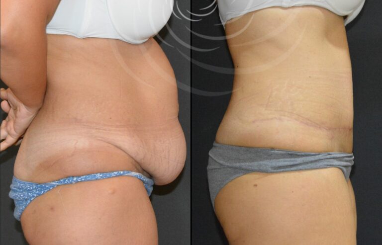 plastyka brzucha 1 6