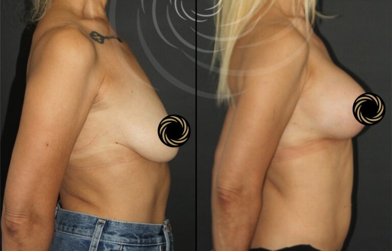 plastyka piersi 1 10