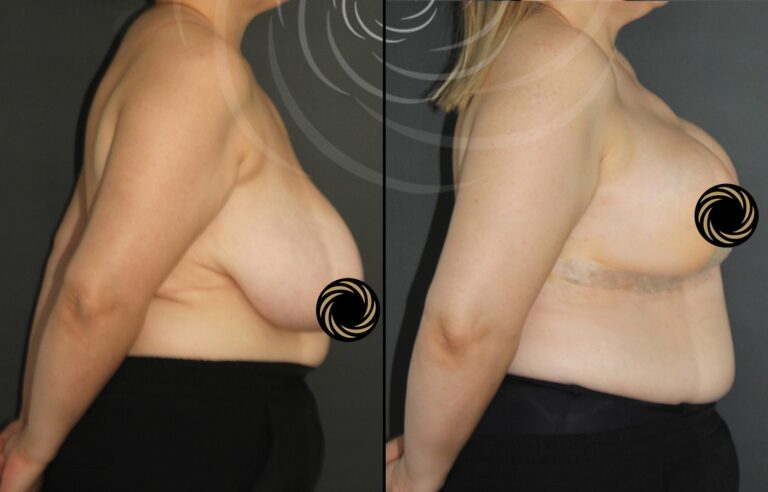 plastyka piersi 1 14
