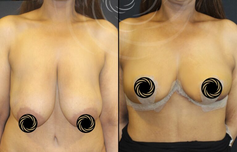 plastyka piersi 1 15
