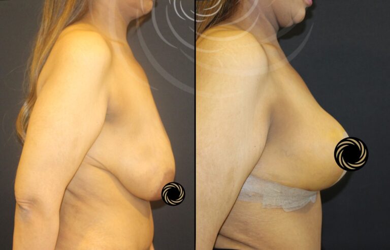 plastyka piersi 1 16