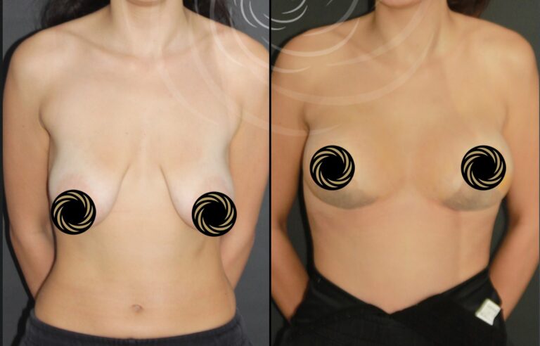 plastyka piersi 1 2