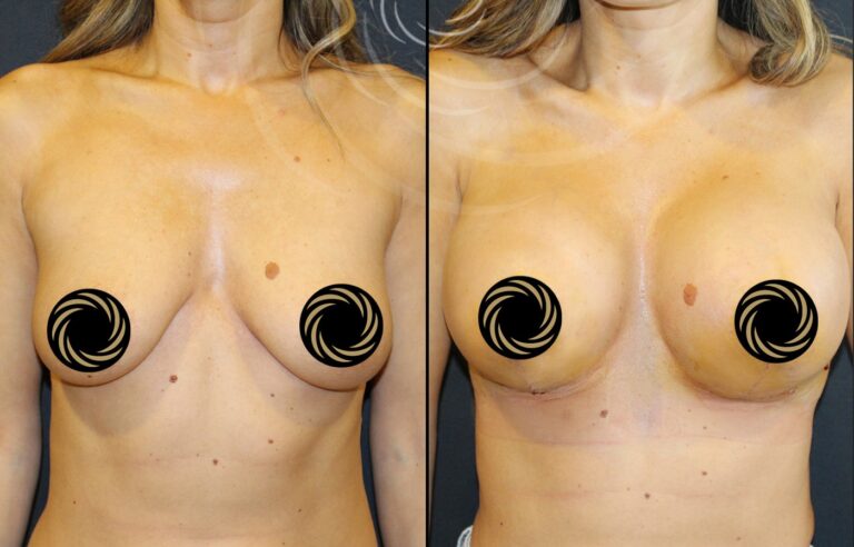 plastyka piersi 1 3