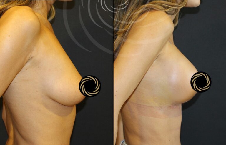 plastyka piersi 1 6