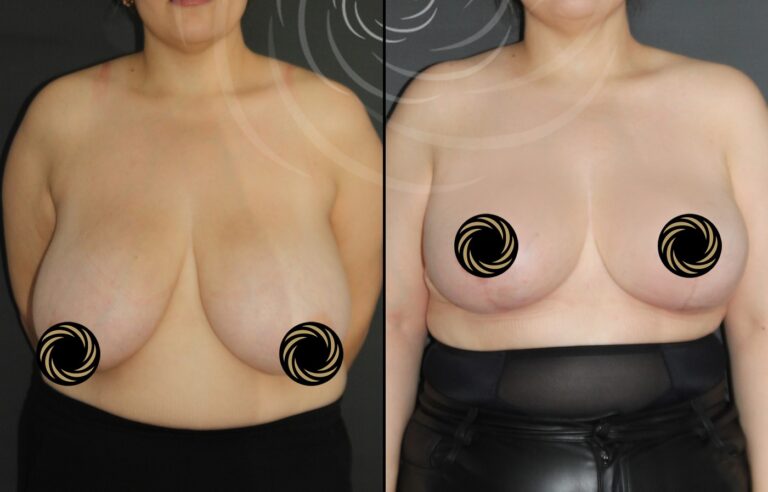 plastyka piersi 1 8