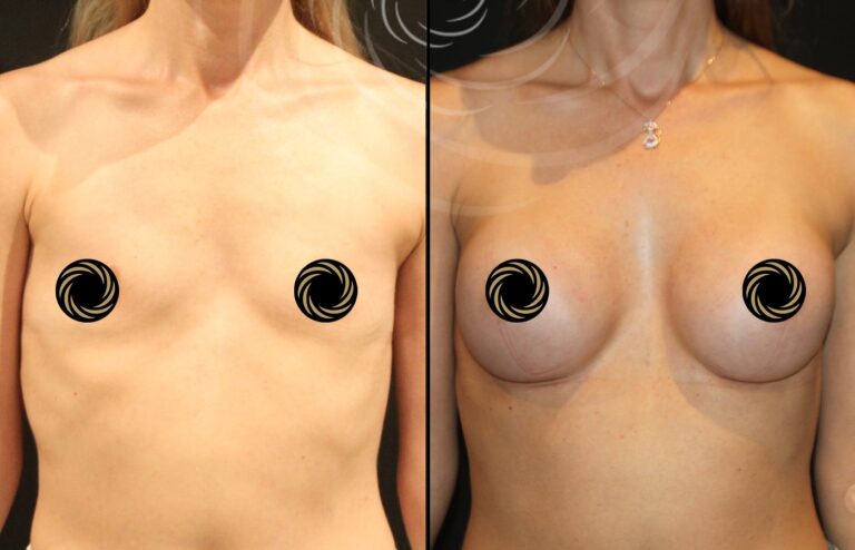 powiekszenie piersi 1 1
