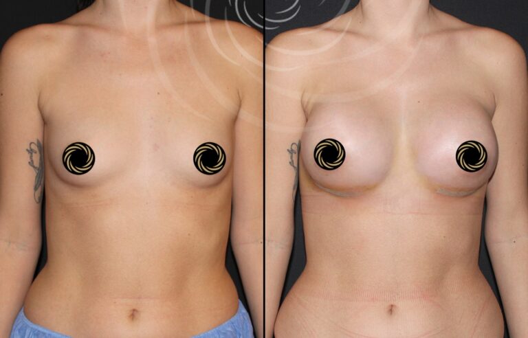 powiekszenie piersi 1 4