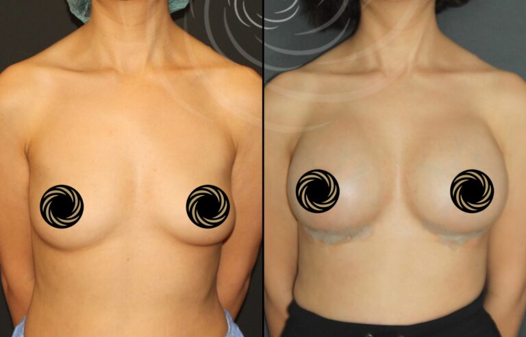 powiekszenie piersi 1 5