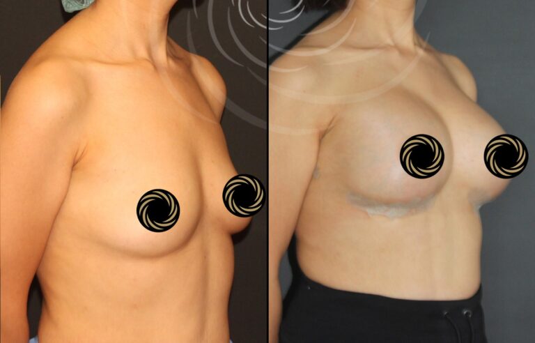 powiekszenie piersi 1 7