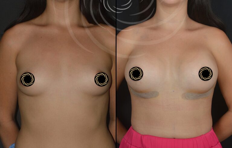 powiekszenie piersi 1 8