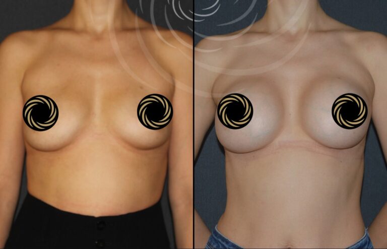 powiekszenie piersi 1 8