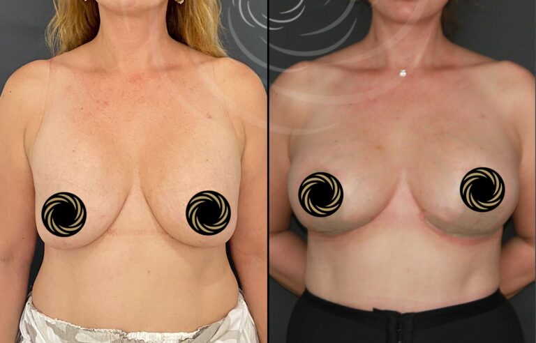 powiekszenie plastyka piersi 1 7
