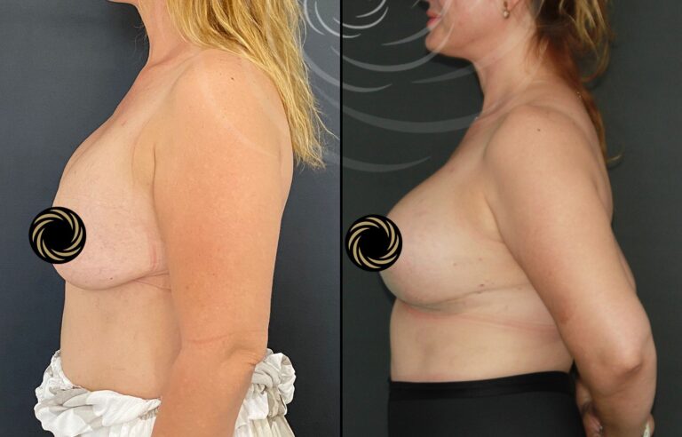 powiekszenie plastyka piersi 1 8