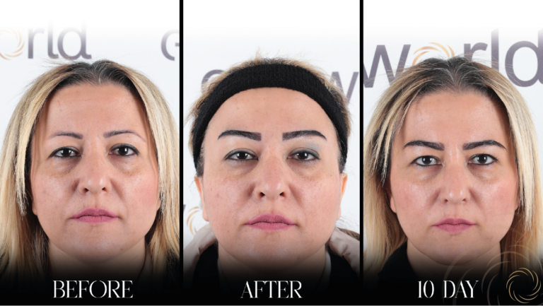 przeszczep brwi 1 11