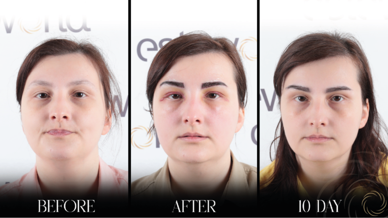 przeszczep brwi 1 13