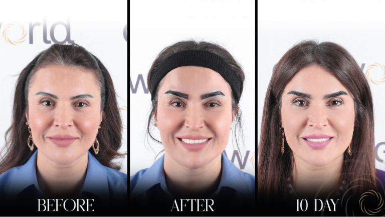 przeszczep brwi 1 14