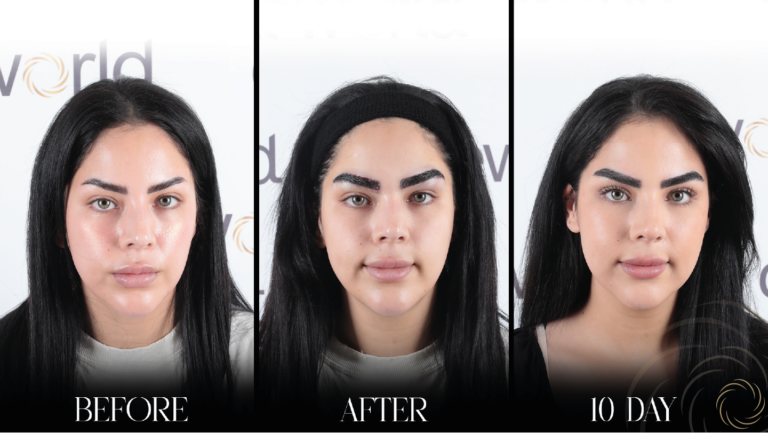 przeszczep brwi 1 15