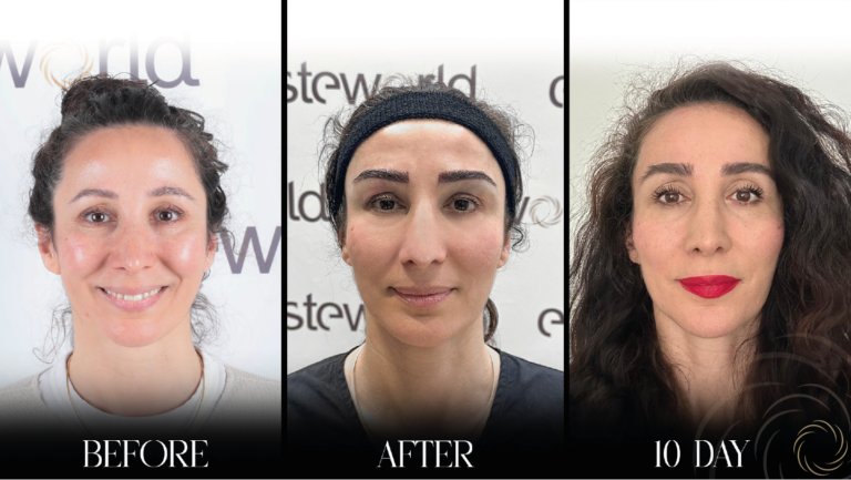 przeszczep brwi 1 17