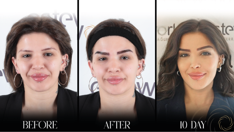 przeszczep brwi 1 18