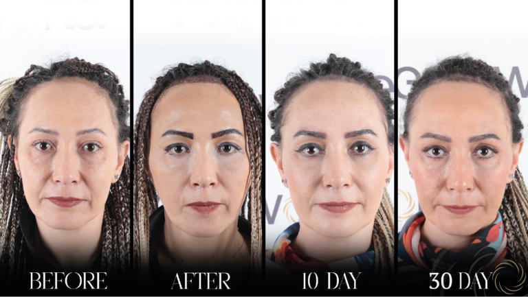 przeszczep brwi 1 19