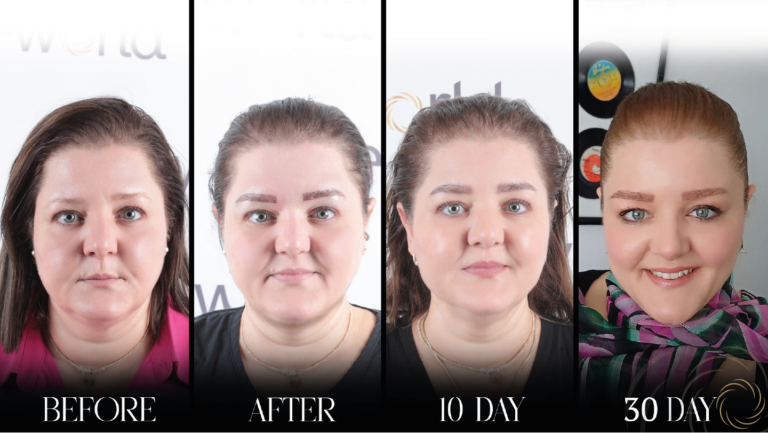 przeszczep brwi 1 20