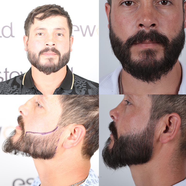 przeszczep zarostu 1 1