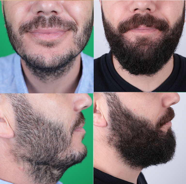 przeszczep zarostu 1 2