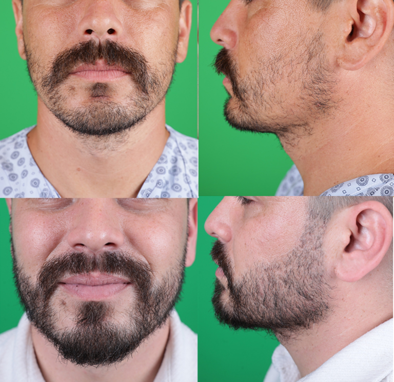 przeszczep zarostu 1 3