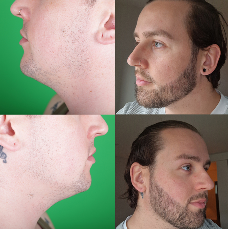 przeszczep zarostu 1 4